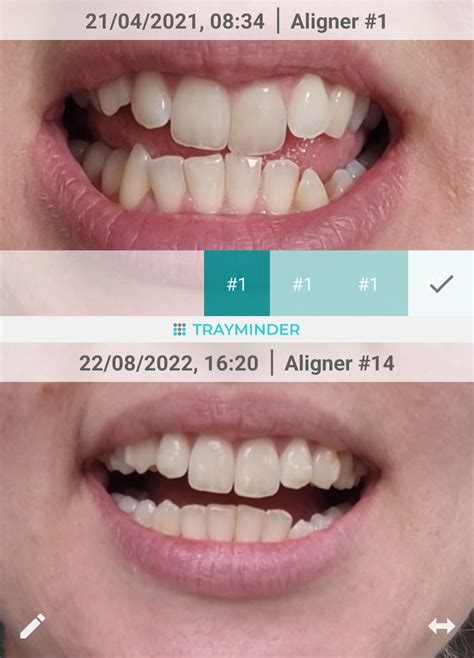 Моят опит с алайнери Invisalign от началото до края! • Всичко за алайнерите