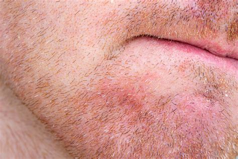 The 9 Best Face Washes For Seborrheic Dermatitis That Work