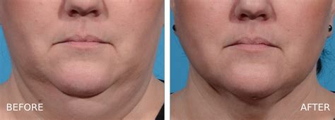 FaceTite Before and After - Joseph Eye and Laser