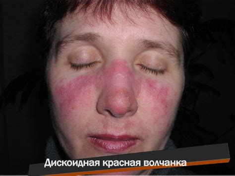 Красная волчанка - презентация онлайн
