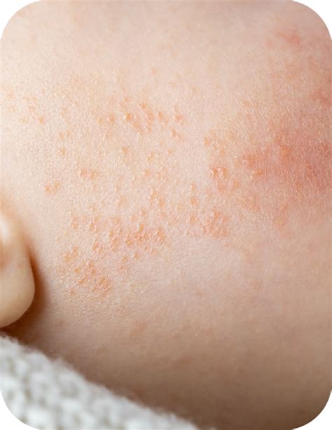 Baby's skin condition: Eczema | CMPA's Symptoms