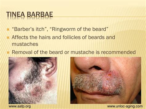 PPT - Tinea and Dermatitis PowerPoint Presentation, free download - ID ...