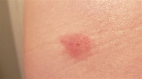 horsefly bite symptoms pictures treatment
