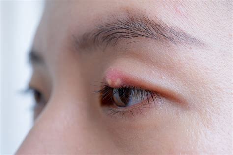 What is a Stye? (aka Hordeolum) Stye Symptoms and Treatments