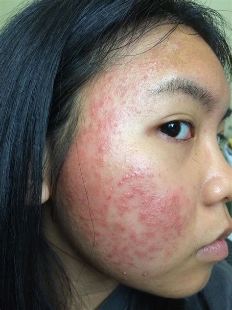 Allergic reaction to acne.org regimen ? – Acne.org products – Acne.org ...