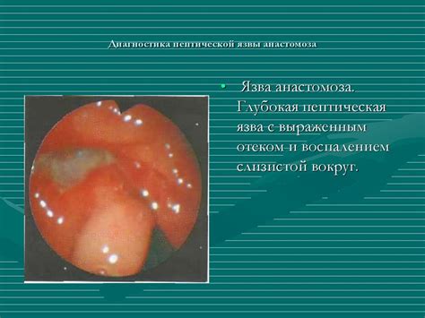 Болезни оперированного желудка. Резекция желудка - online presentation