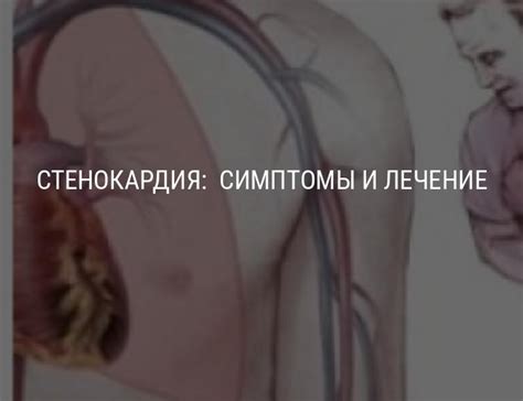 Стенокардия: симптомы и лечение, что делать при стенокардии ...