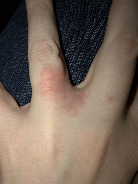 Suddenly allergic to wedding rings I’ve been wearing for 10 years? : r