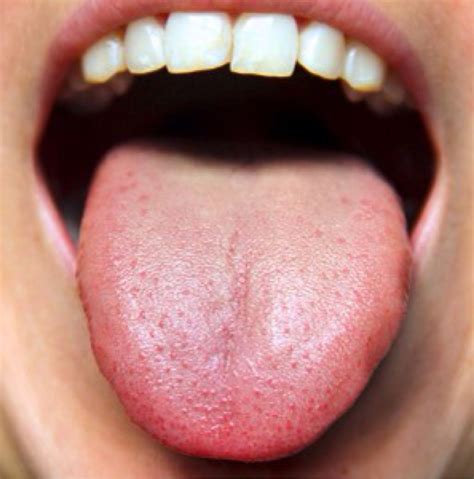 You Can’t Ignore These Things Your Tongue is Warning You About ...