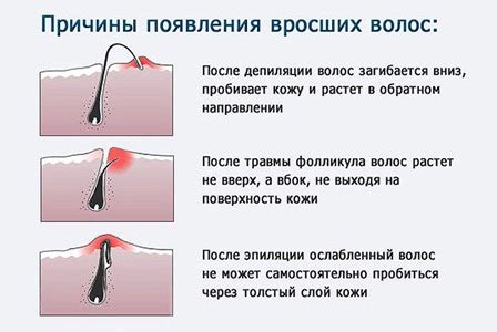 Восковая депиляция в домашних условиях или шугаринг: что лучше в зоне ...