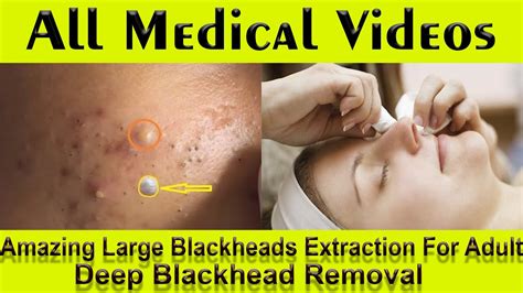 Blackhead Removal Videos May 2024 - Rhody Kristine