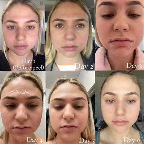 chemical peel aftercare glowday chemical peel yyip