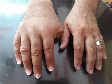 artificial silicone hand prosthesis   elbow  piece