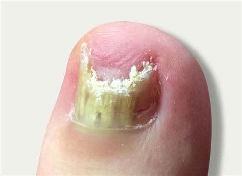 Fungal Nails - Davenport House Clinic