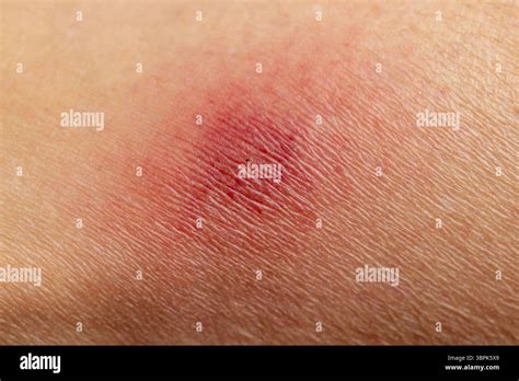 lyme disease   bacterial infection spread  humans   bite