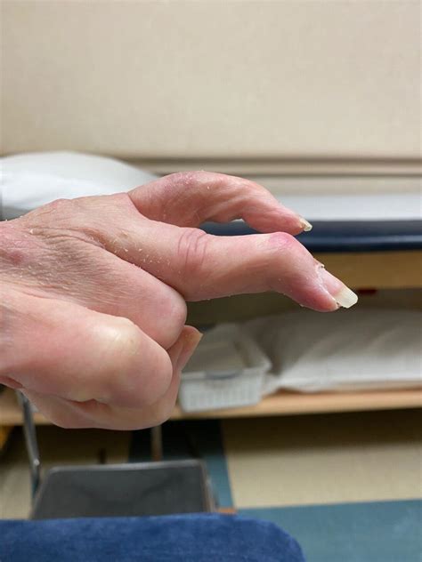 OrthoDx: Swan Neck Deformity - Clinical Advisor