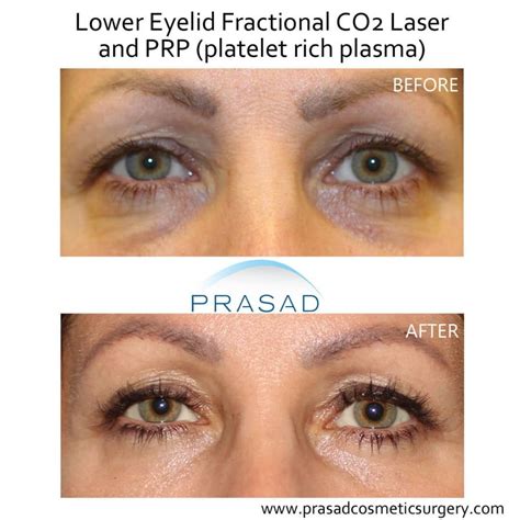 Laser Treatment for Dark Circles Under Eyes | Dr. Prasad Blog