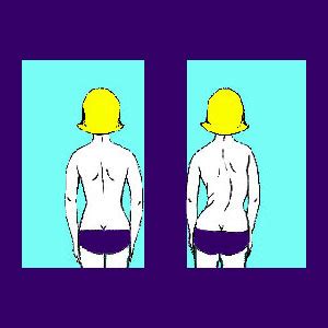 Juvenile Scoliosis - Back Pain