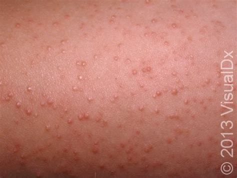 Red Bumps On Arms Not Itchy