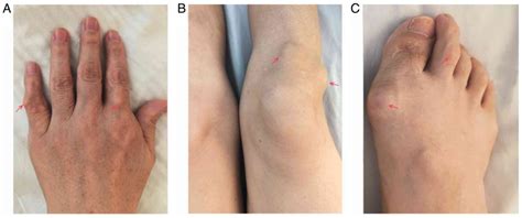 Spinal gout with intervertebral foramen infiltration: A rare case ...