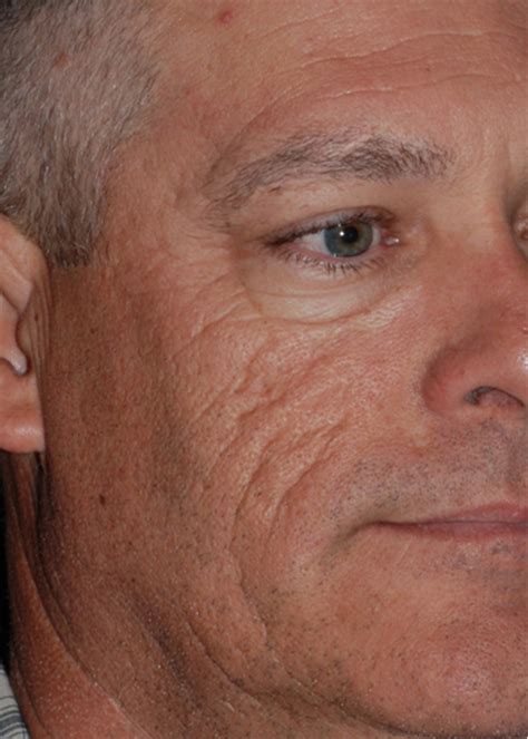 Before & After Malar Bags / Festoons in Atlanta, GA | Oculus