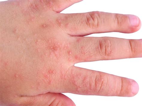 Could Celiac Disease Could Be Sabotaging Your Health? - Healthdish