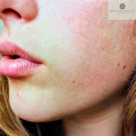 Redness Prone Skin: Rosacea Awareness Month - Skin Essentials by Mariga ...