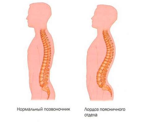 Лордоз поясничного отдела: причины, симптомы, лечение