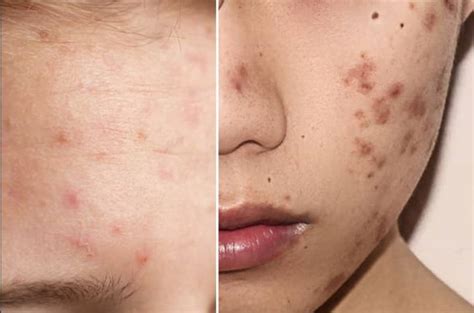 skin purging  breakouts explained