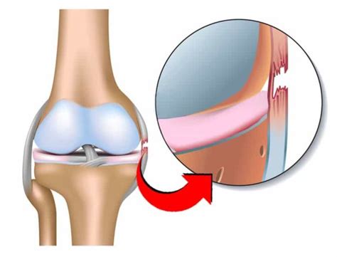 Large Knee Ligament Tear – Arthritis and Injury Care