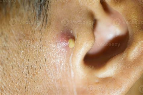 Pus coming from nodular cystic acne in front of the man ear 35167255