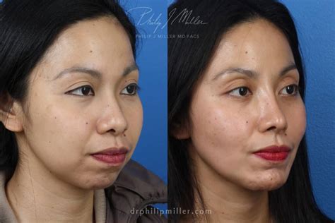 bulbous nose tip philip miller md