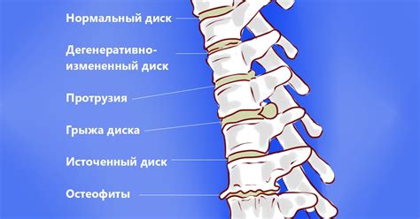 Упражнения при поясничной грыже