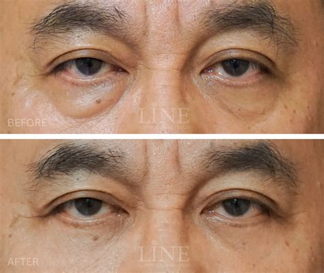 how to fix one eyelid lower than the other