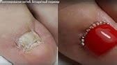 Восстановление ногтя медицинским гелем. Салон Елены Lange. Тюмень - YouTube