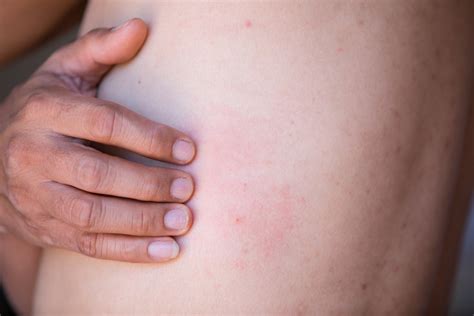 Shingles Rash Early Stages