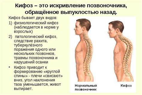 Кіфоз - ступеня, причини, симптоми, способи лікування - Ваш Аптекар