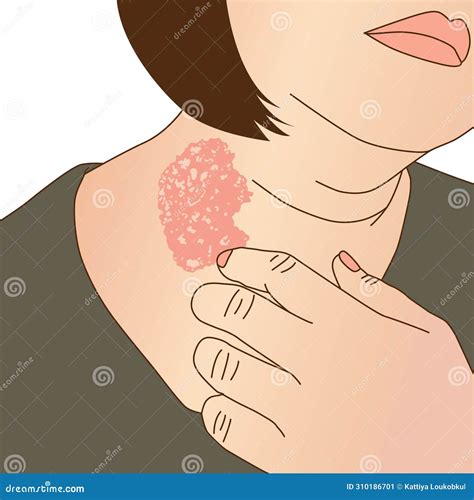 Tinea Versicolor. Human Body With Symptoms Of Pityriasis Versicolor