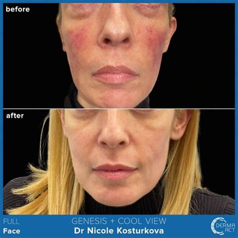 Розацея - причини, диагностика и лечение | Derma-Act