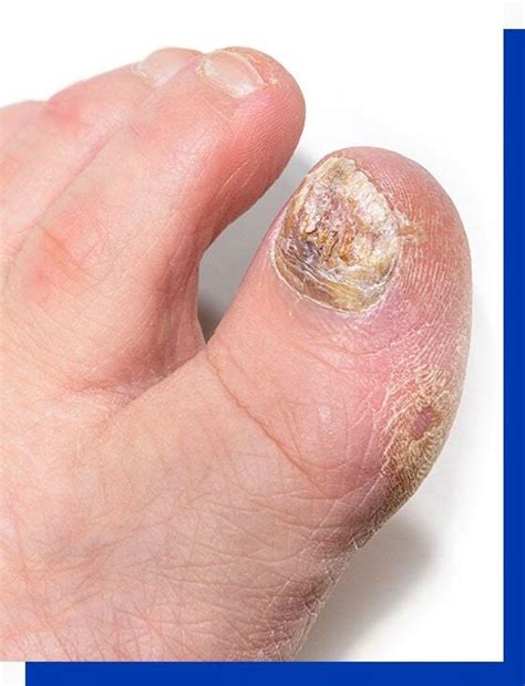 yellow black toe nail fungus nail biting disorder treatment