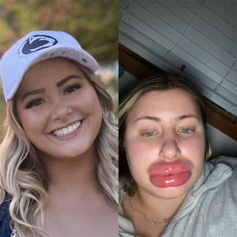 Lips Swollen After Filler | Lipstutorial.org