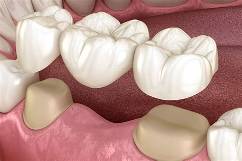 Зъбен мост — Amaya Dental Clinic