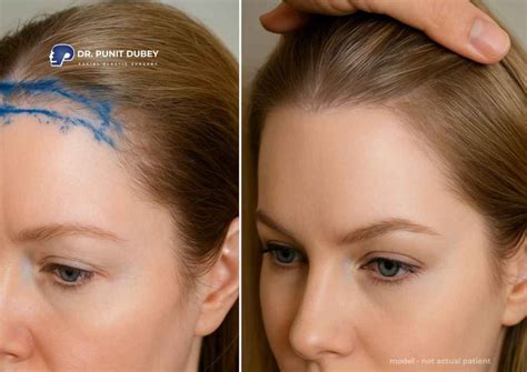 forehead reduction surgery hairline lowering surgery