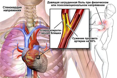 Стенокардия напряжения: что это такое, классификация, лечение и симптомы