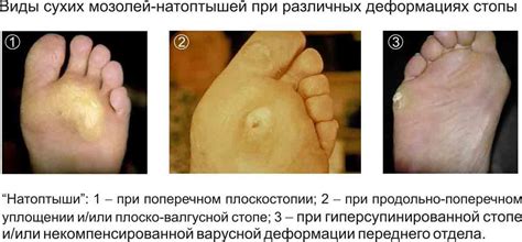 Пластырь от сухих мозолей и натоптышей со стержнем на ногах
