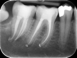 Molar Root Canal Treatment - Dr. Ashish Shah