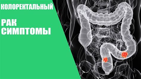 КОЛОРЕКТАЛЬНЫЙ РАК/Симптомы - YouTube