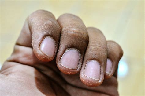 fingertips peeling