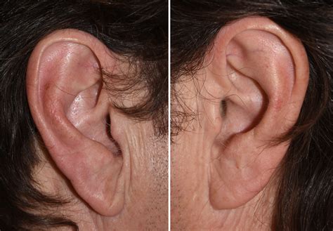 Plastic Surgery Case Study - Male Total Ear Reshaping - Explore Plastic ...