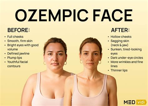 “Ozempic Face” & Facial Ageing After Rapid Weight Loss: What It Is and